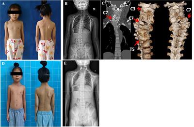 Minimally invasive spine surgery strategy for congenital cervicothoracic scoliosis in children: Less blood loss and shortened segmental fusions/fewer pedical screws